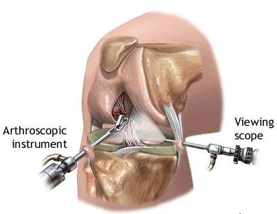 arthroscopic surgery for osteoarthritis provides no benefit