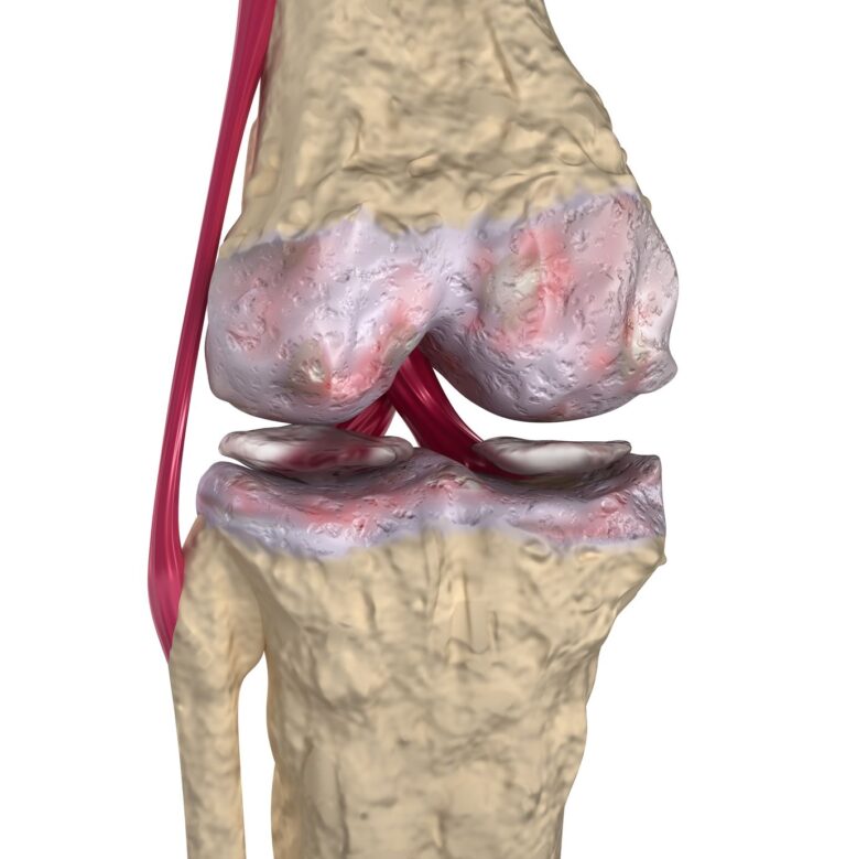curcumin better than NSAID diclofenac Voltaren for osteoarthritis