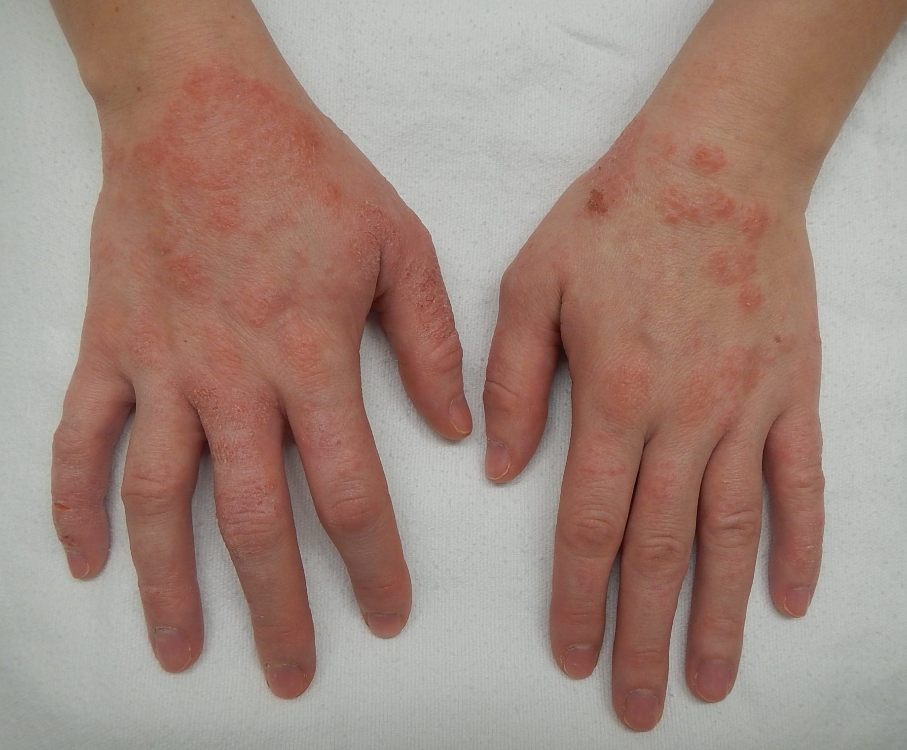 dwarf elder cream as effective as hydrocortisone for eczema