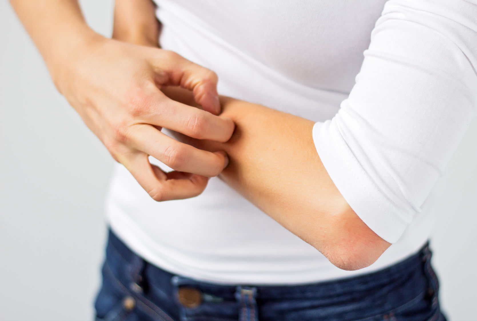 Natural Topical Relief for Eczema
