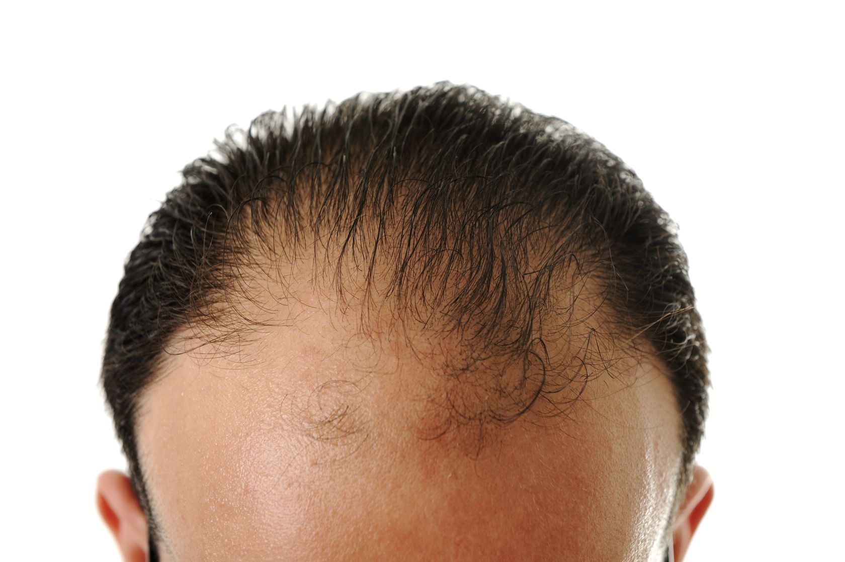 Reversing Hair Loss Naturally
